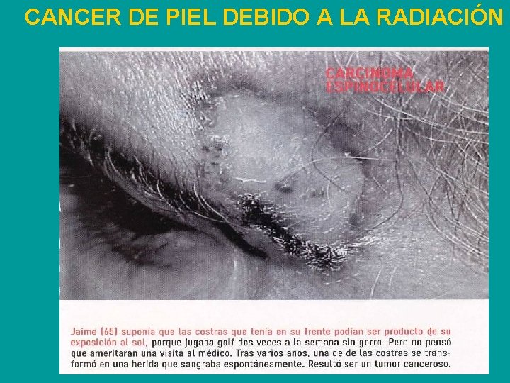 CANCER DE PIEL DEBIDO A LA RADIACIÓN 