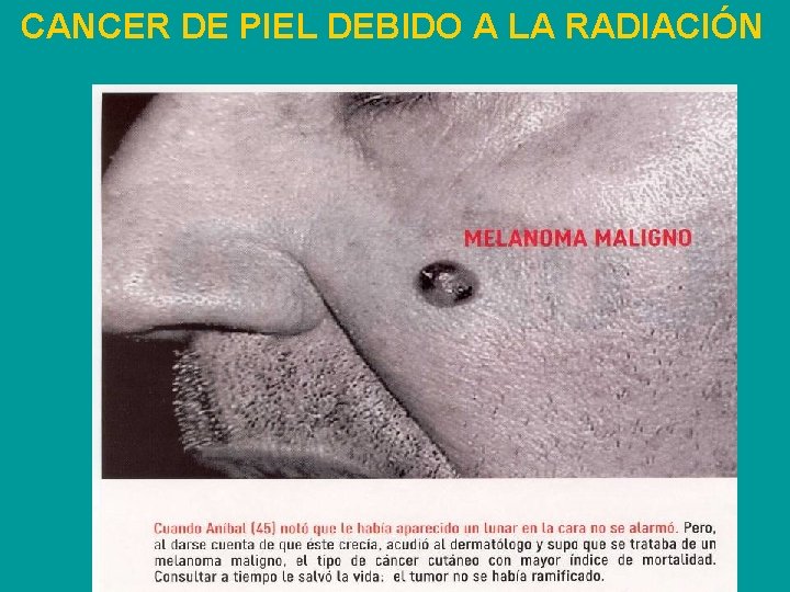 CANCER DE PIEL DEBIDO A LA RADIACIÓN 