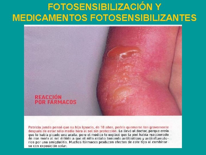 FOTOSENSIBILIZACIÓN Y MEDICAMENTOS FOTOSENSIBILIZANTES 