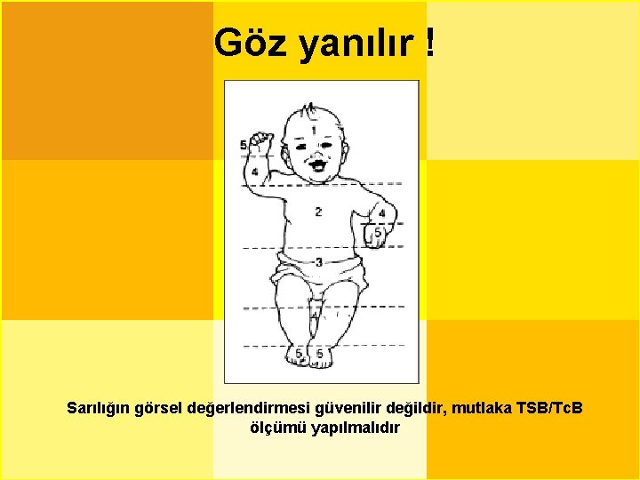 Göz yanılır ! Sarılığın görsel değerlendirmesi güvenilir değildir, mutlaka TSB/Tc. B ölçümü yapılmalıdır 