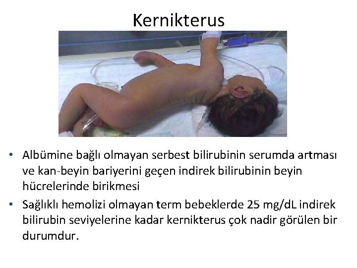Kernikterus • Albümine bağlı olmayan serbest bilirubinin serumda artması ve kan-beyin bariyerini geçen indirek