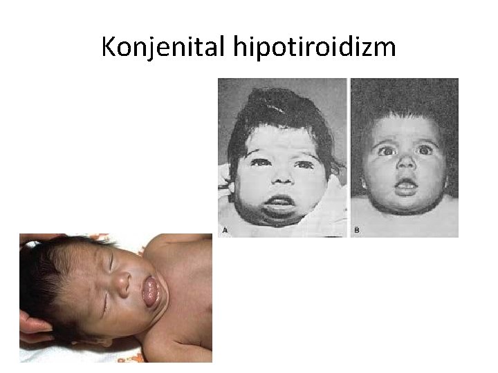 Konjenital hipotiroidizm 