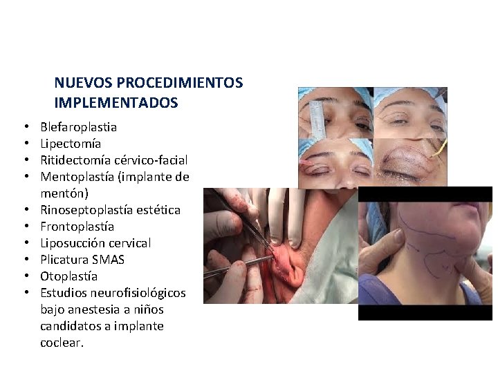 NUEVOS PROCEDIMIENTOS IMPLEMENTADOS • • • Blefaroplastia Lipectomía Ritidectomía cérvico-facial Mentoplastía (implante de mentón)