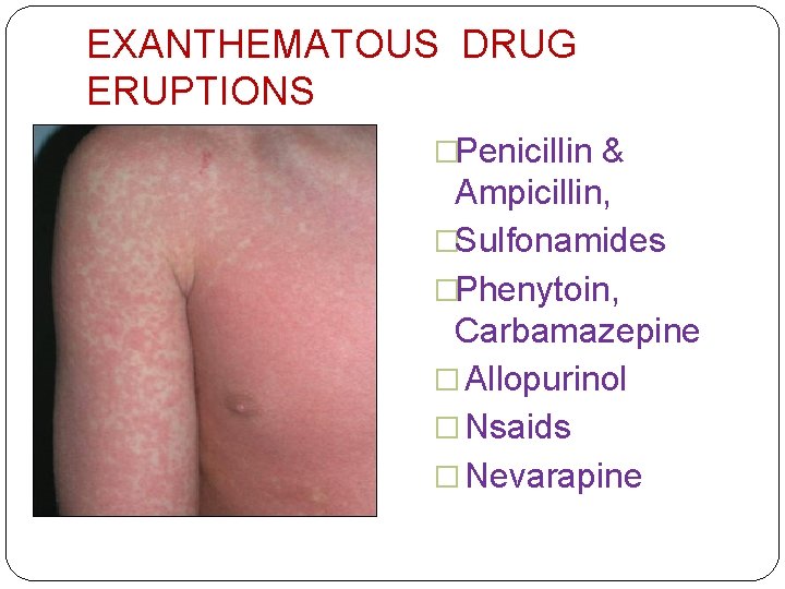 EXANTHEMATOUS DRUG ERUPTIONS �Penicillin & Ampicillin, �Sulfonamides �Phenytoin, Carbamazepine � Allopurinol � Nsaids �
