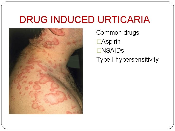 DRUG INDUCED URTICARIA Common drugs �Aspirin �NSAIDs Type I hypersensitivity 