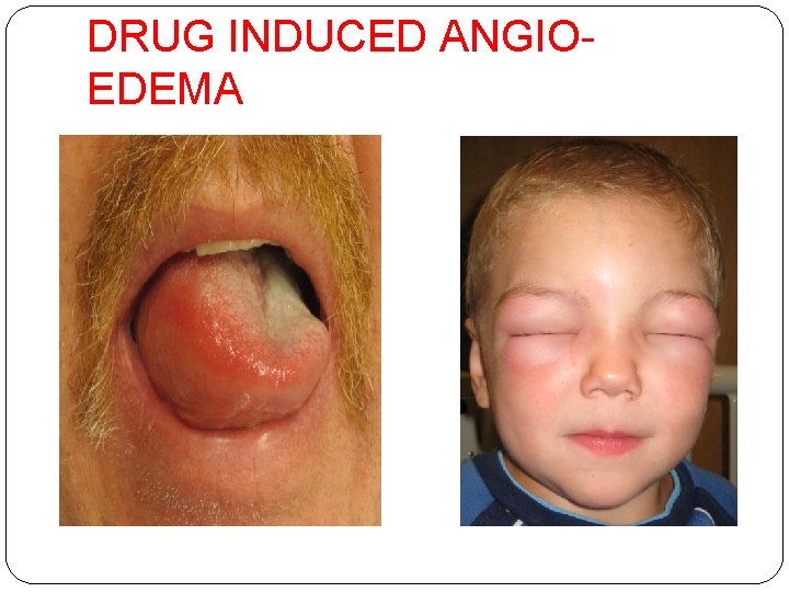 DRUG INDUCED ANGIOEDEMA 