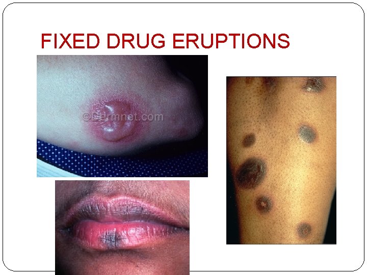 FIXED DRUG ERUPTIONS 