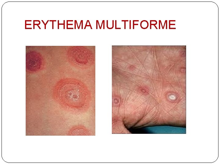 ERYTHEMA MULTIFORME 