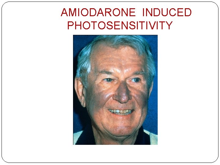 AMIODARONE INDUCED PHOTOSENSITIVITY 