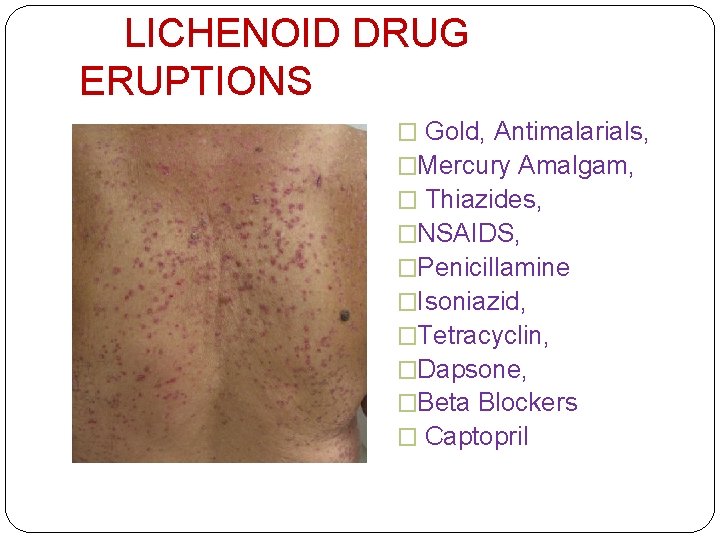 LICHENOID DRUG ERUPTIONS � Gold, Antimalarials, �Mercury Amalgam, � Thiazides, �NSAIDS, �Penicillamine �Isoniazid, �Tetracyclin,