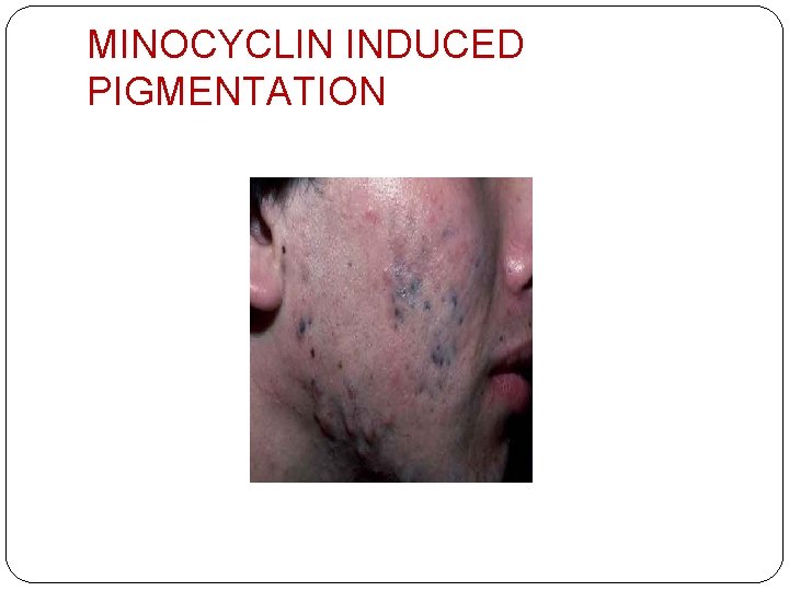 MINOCYCLIN INDUCED PIGMENTATION 