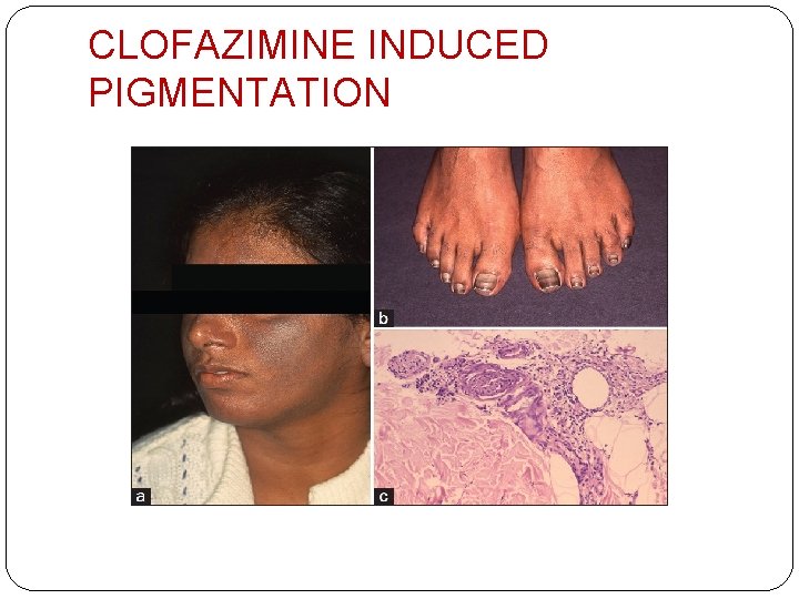 CLOFAZIMINE INDUCED PIGMENTATION 