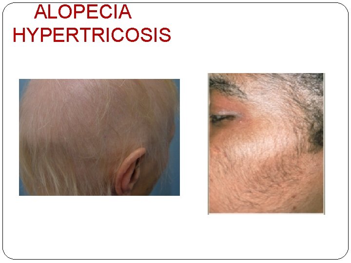 ALOPECIA HYPERTRICOSIS 