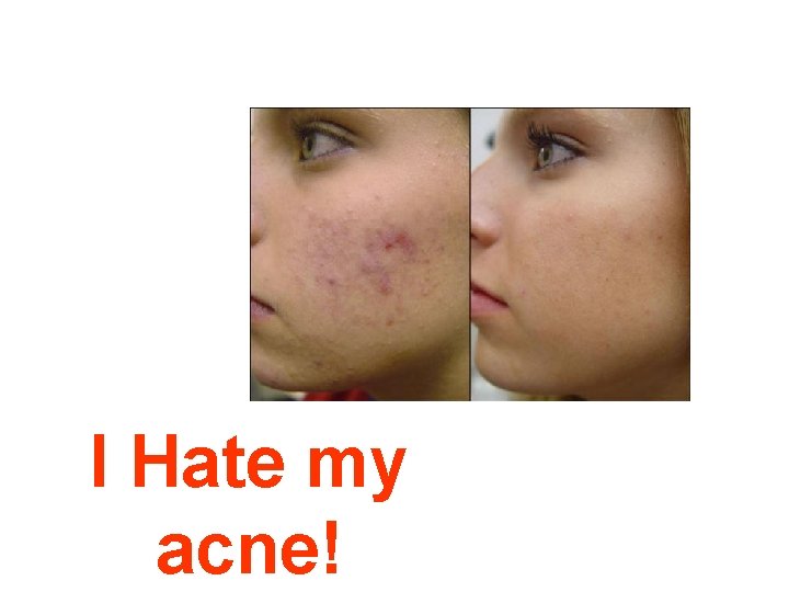 I Hate my acne! 