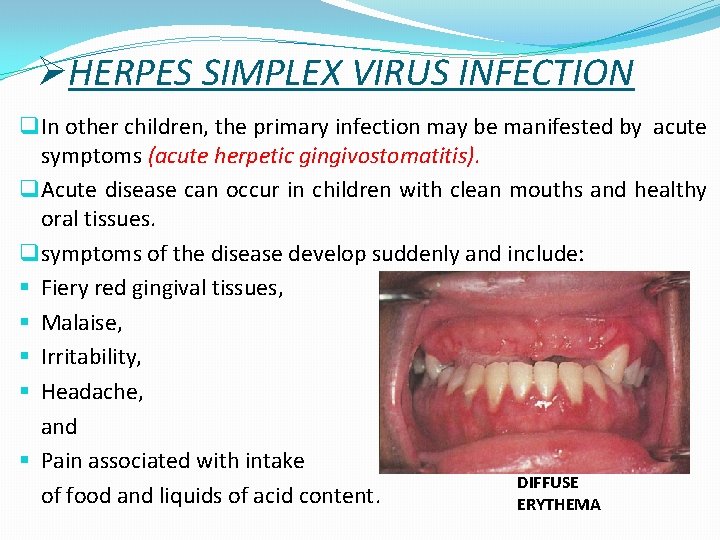 ØHERPES SIMPLEX VIRUS INFECTION q In other children, the primary infection may be manifested
