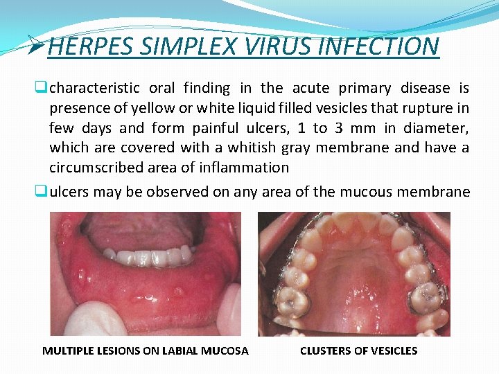 ØHERPES SIMPLEX VIRUS INFECTION q characteristic oral finding in the acute primary disease is