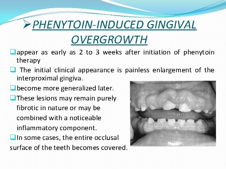 ØPHENYTOIN-INDUCED GINGIVAL OVERGROWTH q appear as early as 2 to 3 weeks after initiation