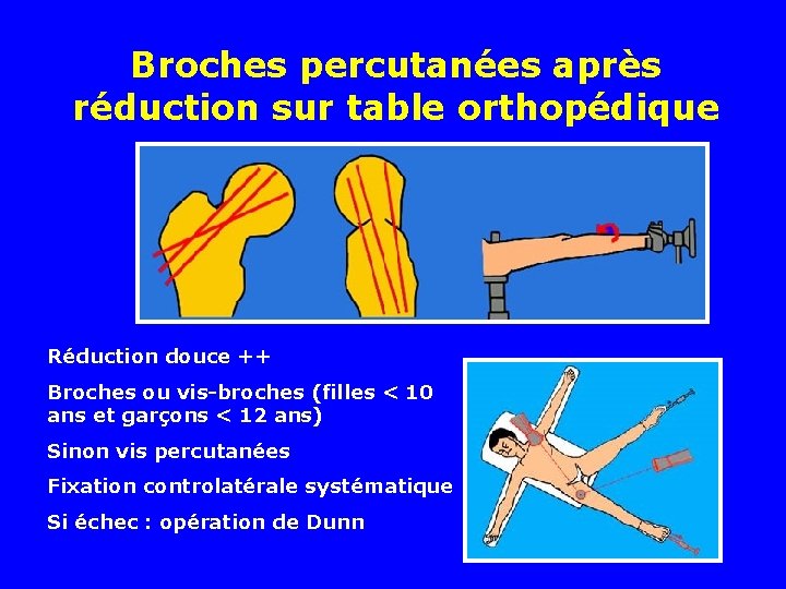 Broches percutanées après réduction sur table orthopédique Réduction douce ++ Broches ou vis-broches (filles