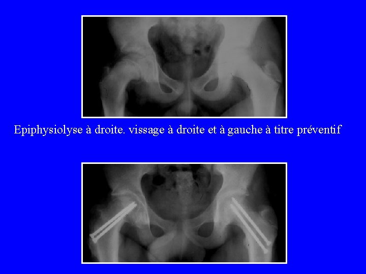 Epiphysiolyse à droite. vissage à droite et à gauche à titre préventif 