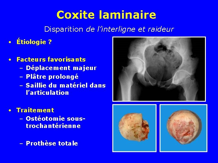 Coxite laminaire Disparition de l’interligne et raideur • Étiologie ? • Facteurs favorisants –