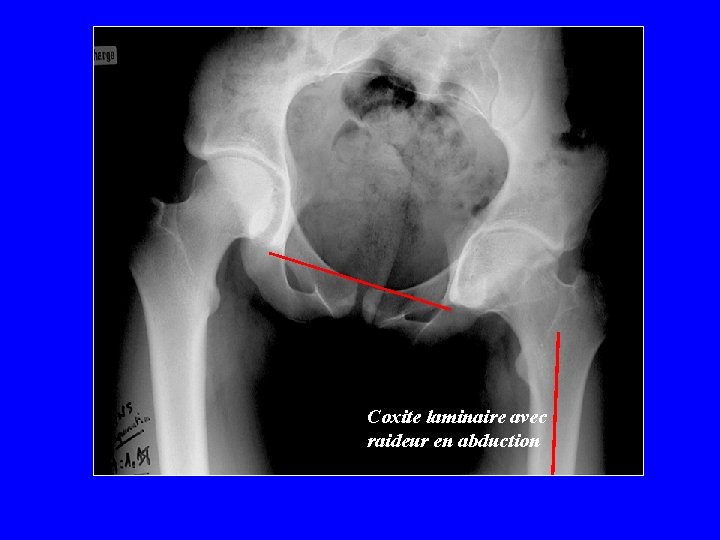 Coxite laminaire avec raideur en abduction 