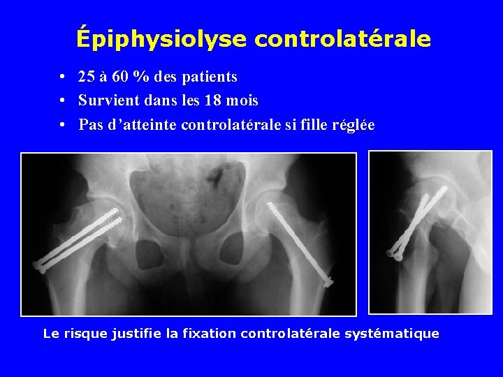 Épiphysiolyse controlatérale • 25 à 60 % des patients • Survient dans les 18