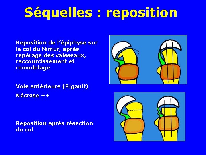 Séquelles : reposition Reposition de l’épiphyse sur le col du fémur, après repérage des