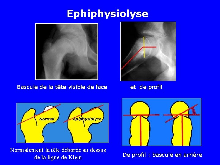 Ephiphysiolyse Bascule de la tête visible de face Normal et de profil épiphysiolyse Normalement