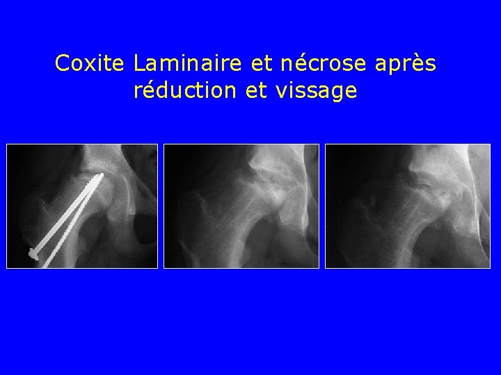 Coxite Laminaire et nécrose après réduction et vissage 