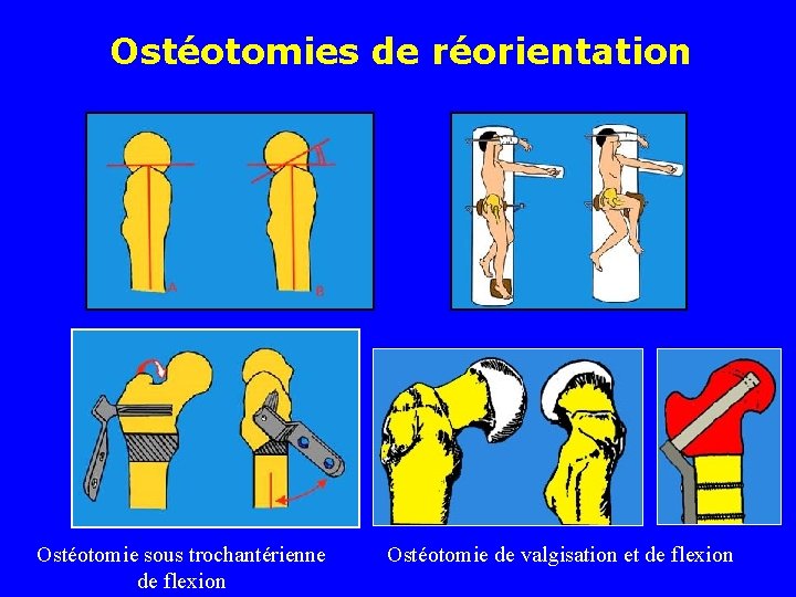 Ostéotomies de réorientation Ostéotomie sous trochantérienne de flexion Ostéotomie de valgisation et de flexion
