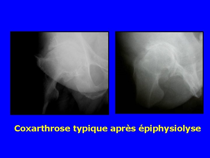 Coxarthrose typique après épiphysiolyse 