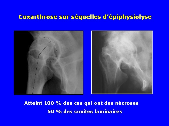 Coxarthrose sur séquelles d’épiphysiolyse Atteint 100 % des cas qui ont des nécroses 50