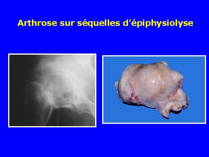Arthrose sur séquelles d’épiphysiolyse 