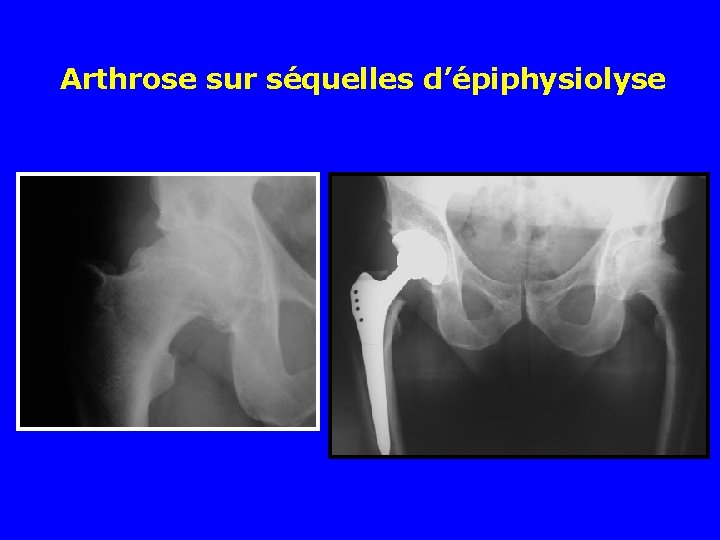 Arthrose sur séquelles d’épiphysiolyse 