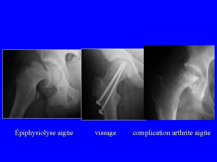 Épiphysiolyse aigüe vissage complication arthrite aigüe 