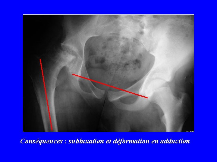 Conséquences : subluxation et déformation en adduction 