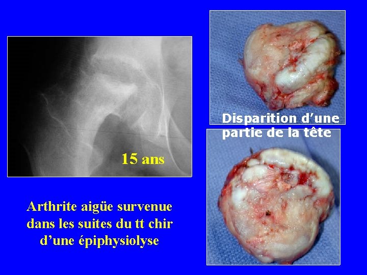 Disparition d’une partie de la tête 15 ans Arthrite aigüe survenue dans les suites