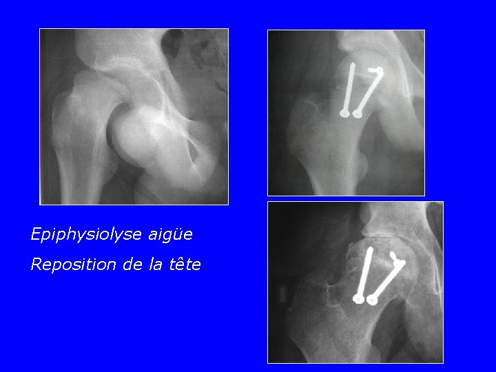 Epiphysiolyse aigüe Reposition de la tête 