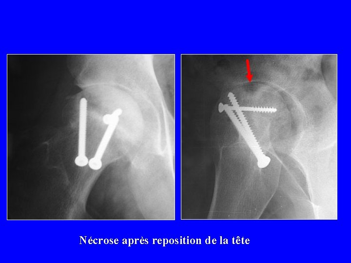 Nécrose après reposition de la tête 