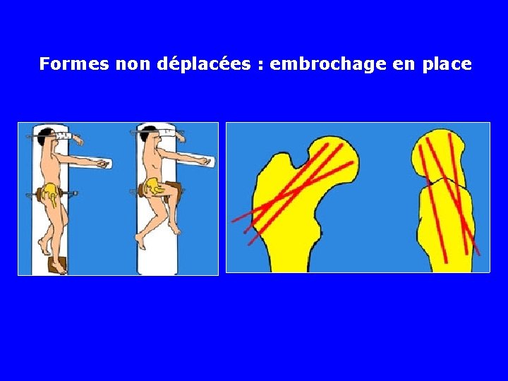 Formes non déplacées : embrochage en place 