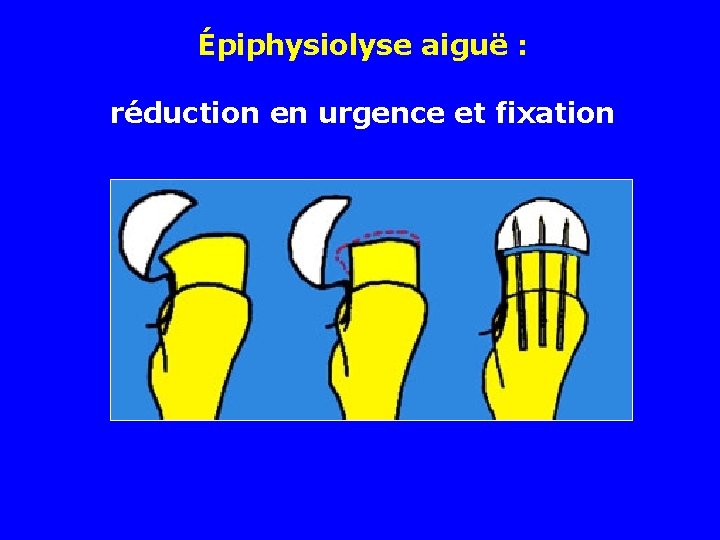 Épiphysiolyse aiguë : réduction en urgence et fixation 