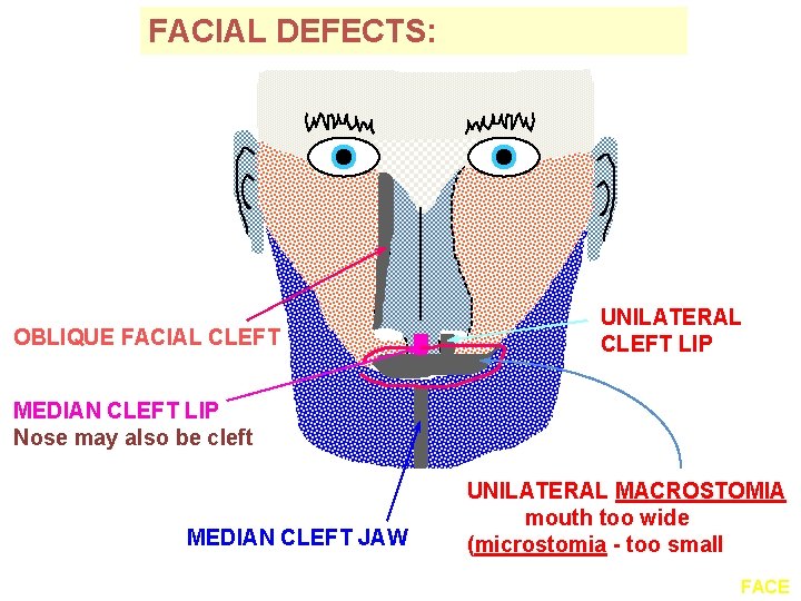 FACIAL DEFECTS: OBLIQUE FACIAL CLEFT UNILATERAL CLEFT LIP MEDIAN CLEFT LIP Nose may also