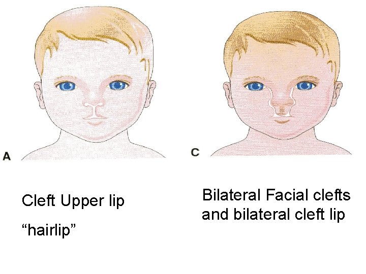 Cleft Upper lip “hairlip” Bilateral Facial clefts and bilateral cleft lip 