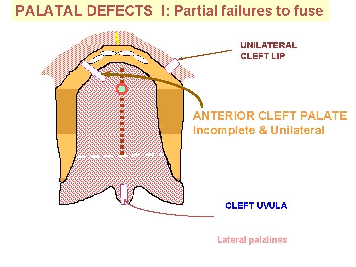 PALATAL DEFECTS I: Partial failures to fuse UNILATERAL CLEFT LIP ANTERIOR CLEFT PALATE Incomplete