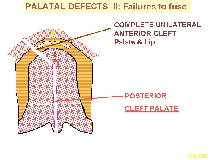 PALATAL DEFECTS II: Failures to fuse COMPLETE UNILATERAL ANTERIOR CLEFT Palate & Lip POSTERIOR