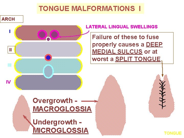 TONGUE MALFORMATIONS I ARCH I LATERAL LINGUAL SWELLINGS Failure of these to fuse properly