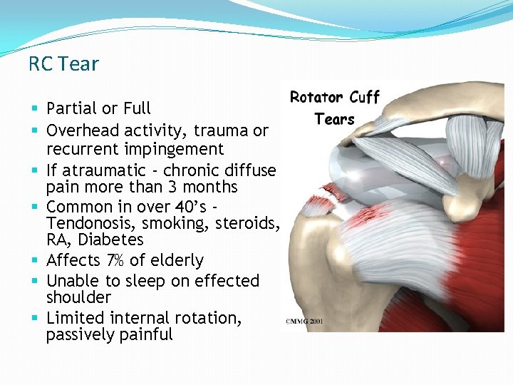 RC Tear § Partial or Full § Overhead activity, trauma or recurrent impingement § RC Tear § Partial or Full § Overhead activity, trauma or recurrent impingement §