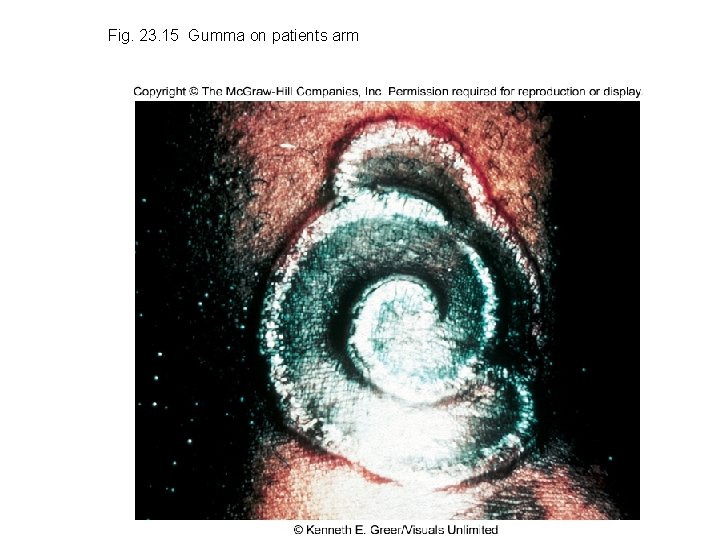 Fig. 23. 15 Gumma on patients arm 