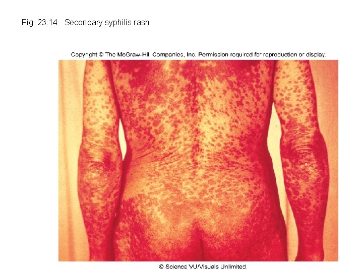 Fig. 23. 14 Secondary syphilis rash 