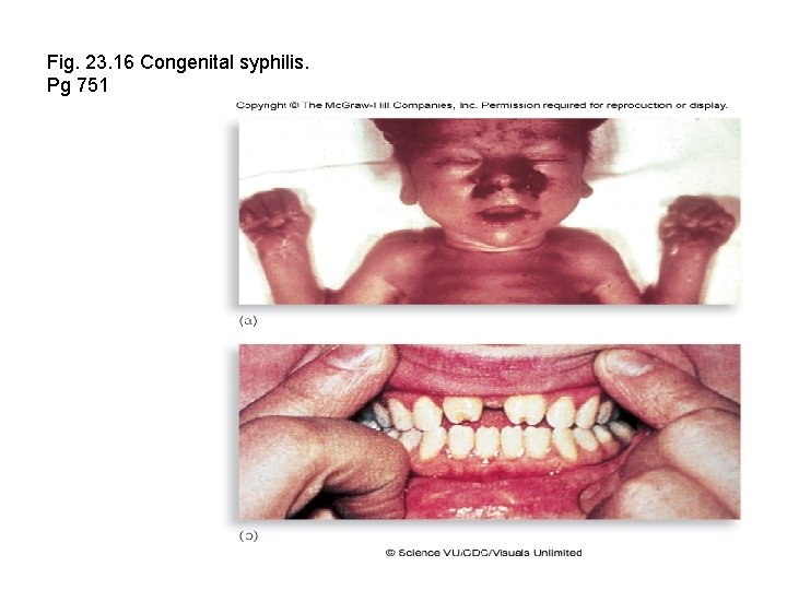 Fig. 23. 16 Congenital syphilis. Pg 751 
